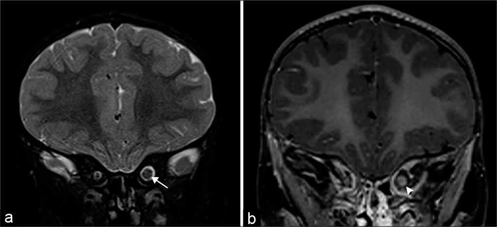 Optic nerve glioma. A 3-year-old patient with neurofibromatosis type 1 who presents with blurred vision. (a) Coronal T2-weighted MR image demonstrates an enlarged left optic nerve (arrow). (b) Coronal T1 post-contrast MR image shows minimal peripheral enhancement (arrowhead).