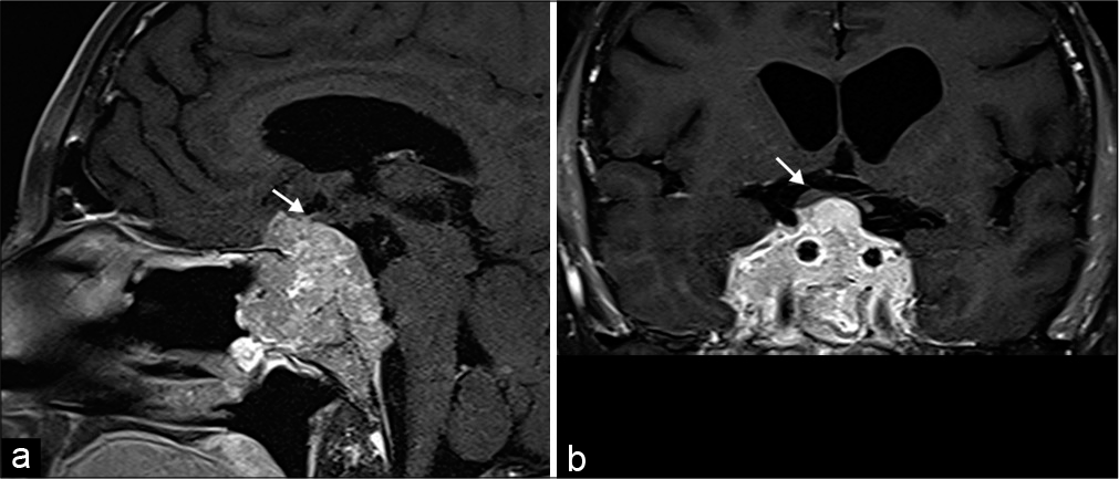 Pituitary Macroadenoma. A 42-year-old male presents with bitemporal hemianopsia. (a and b) Sagittal and coronal T1 post-contrast MR images, respectively, show an enhancing multilobulated mass centered in the sella with extension anteriorly into the sphenoid sinus, inferiorly into the clivus, and superiorly into the suprasellar region. There is mass effect and superior displacement of the optic chiasm (arrows).