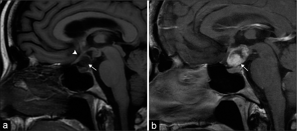 Craniopharyngioma. 50-year-old man with vision changes. (a) Sagittal T1-weighted MR image demonstrates a mixed solid-cystic sellar/suprasellar lesion (arrow), which superiorly displaces the optic chiasm (arrowhead). (b) Sagittal T1 post-contrast MR image demonstrates the predominant solid components of the lesion (arrow).