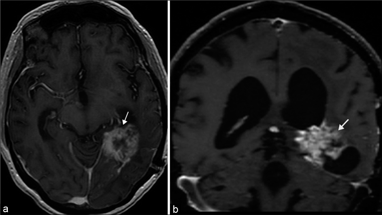 Tumoral disruption of optic radiations. 65-year-old male presented with headache and right homonymous hemianopia, later diagnosed with pathology proven glioblastoma. (a and b) Axial and coronal T1 post-contrast MR images, respectively, demonstrate a heterogeneously enhancing mass situated in the posterior medial left temporal lobe (arrows).