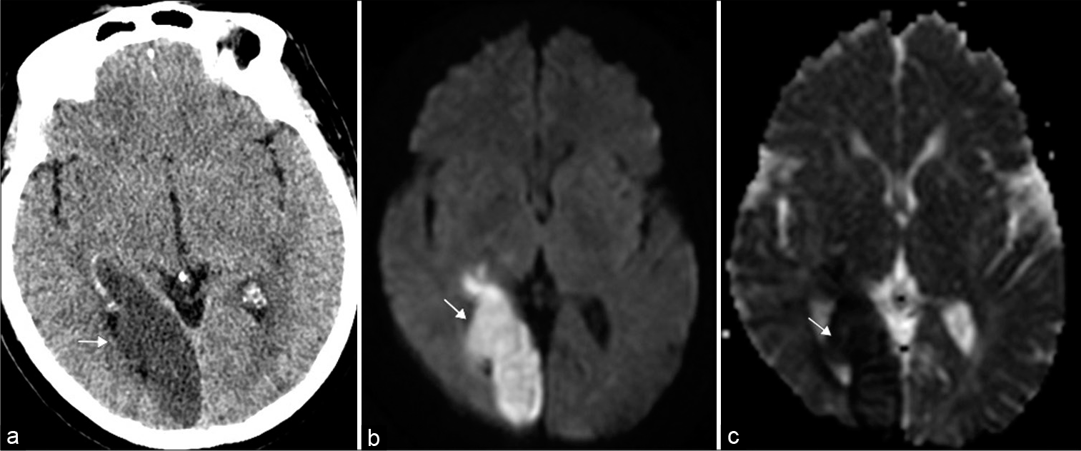 Occipital lobe infarct. 69-year-old woman presented with left homonymous hemianopia. (a) Axial non-contrast head computed tomography illustrates loss of gray-white matter differentiation within the right occipital lobe (arrow). (b and c) Axial DWI (diffusion weighted imaging) and ADC map (apparent diffusion coefficient), respectively, confirm an acute infarct in the right posterior cerebral artery territory (arrows).