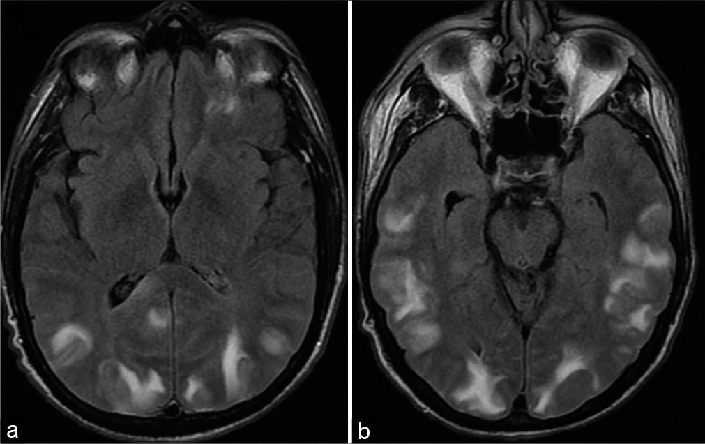Posterior reversible encephalopathy syndrome. A 52-year-old hypertensive male presents with blurry vision. (a and b) Axial T2/ Fluid attenuated inversion recovery MR images shows areas of increased signal representative of vasogenic edema in the cortex and subcortical white matter predominantly distributed in the posterior cerebral hemispheres bilaterally including the occipital lobes.