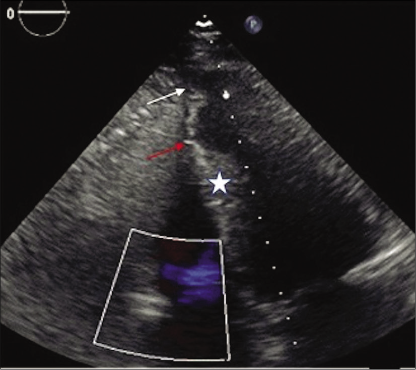 71-year-old male with a history of Q wave myocardial infarction and episodes of chest discomfort. Transthoracic echocardiography in four-chamber view with asymmetrical apical bulging (white arrow), midventricular hypertrophy (asterisk), and apical remodeling (red arrow).