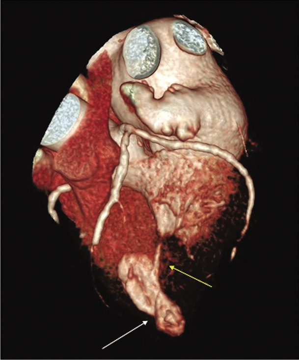 71-year-old male with a history of Q wave myocardial infarction who presented with episodes of chest discomfort with suspicion for an apical LV pseudoaneurysm on echocardiography. Cardiac CT angiography - volume rendering technique reconstruction in systole showing asymmetrical apical bulging with neck narrowing (white arrow). Note almost complete LV lumen obliteration due to mid-ventricular hypertrophy (yellow arrow).