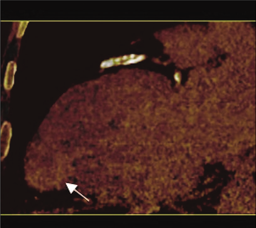 71-year-old male with a history of Q wave myocardial infarction and episodes of chest discomfort with suspicion for an apical LV pseudoaneurysm on echocardiography. Dual-energy CT (delayed enhancement) iodinated map in two-chamber view with increased iodine concentration (yellow arrow) in the wall of the asymmetrical bulging extending to the endocardial area (white arrow) representing myocardial wall fibrosis. These findings confirm true apical LV aneurysm.