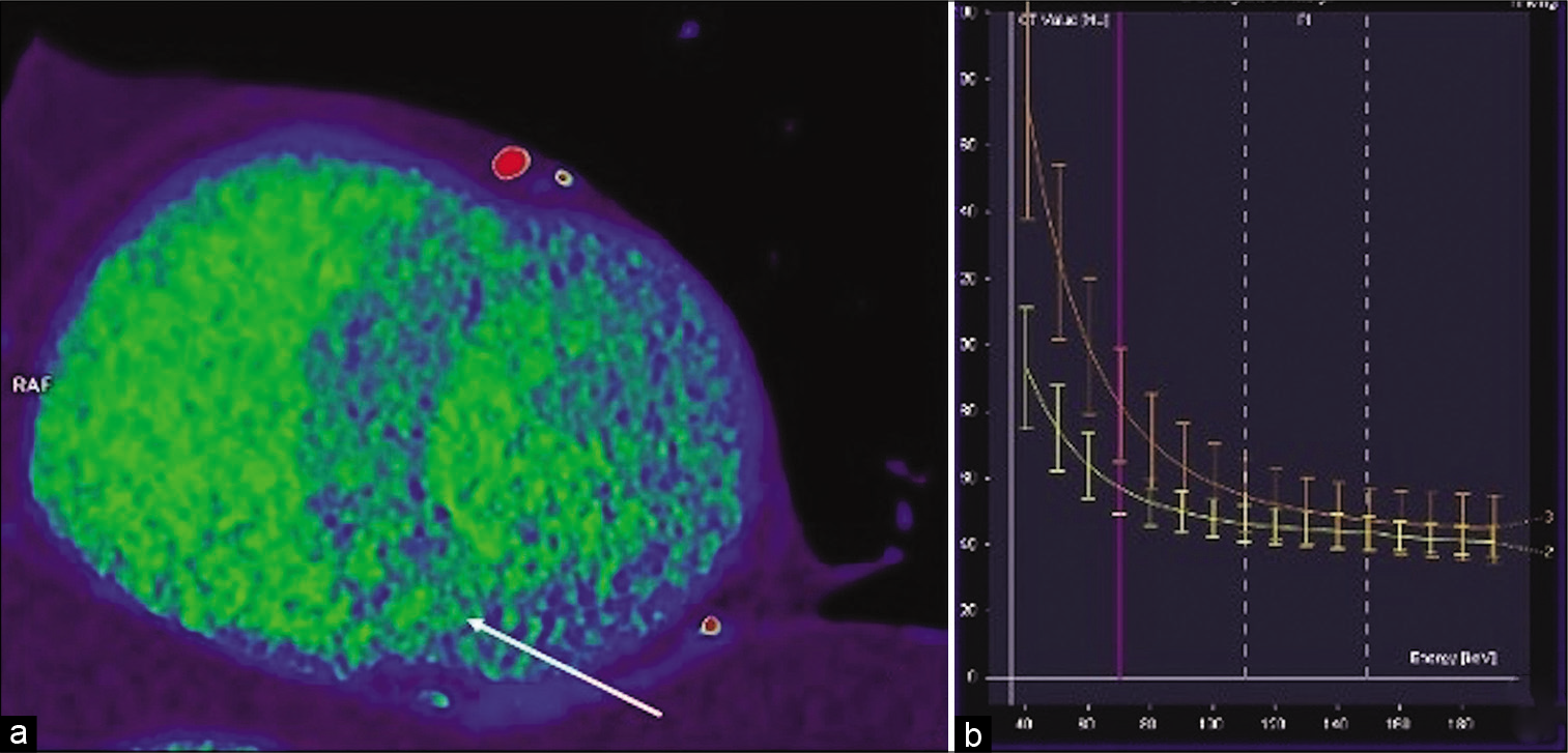 Dual-energy CT delayed enhancement virtual monochromatic image reconstruction at 70 kV in short axis view midventricular (a) showing an inhomogeneous interventricular septum and anterior LV wall with patchy areas of delayed enhancement (arrow) representing fibrotic changes in hypertrophic cardiomyopathy. Dual-energy CT virtual monochromatic image reconstruction at 70 kV -graph of dependence of attenuation (HU) on energy (kV) (b) in normal myocardium (yellow line) and in fibrotic foci in interventricular septum (orange curve). There is an increased difference in attenuation with decreasing energy proving the iodine content and the delayed enhancement of the myocardium’s patchy areas.