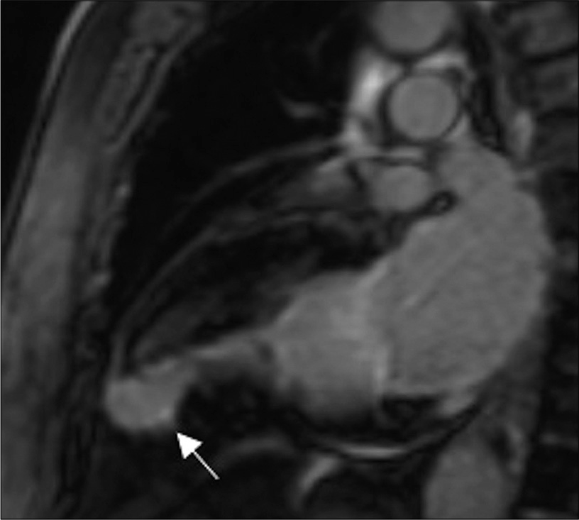 71-year-old male with a history of Q wave myocardial infarction and chest discomfort episodes evaluated for suspect apical LV pseudoaneurysm. Delayed enhancement MRI in the two-chamber view shows increased enhancement in the asymmetrical bulging wall extending to the endocardial area (white arrow). The findings represent a true apical LV aneurysm. Please note an excellent correlation with dualenergy CT image [Figure 3].