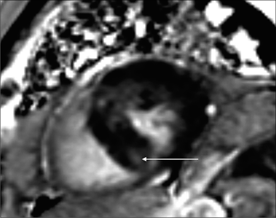 71-year-old male with a history of Q wave myocardial infarction and chest discomfort episodes evaluated for suspect apical LV pseudoaneurysm. Cardiac MRI delayed enhancement image in short axis view midventricular shows patchy areas of enhancement within interventricular septum and anterior LV wall representing fibrotic changes in hypertrophic cardiomyopathy (yellow arrow). Notice the correlation with DECT late enhancement [Figure 4a].