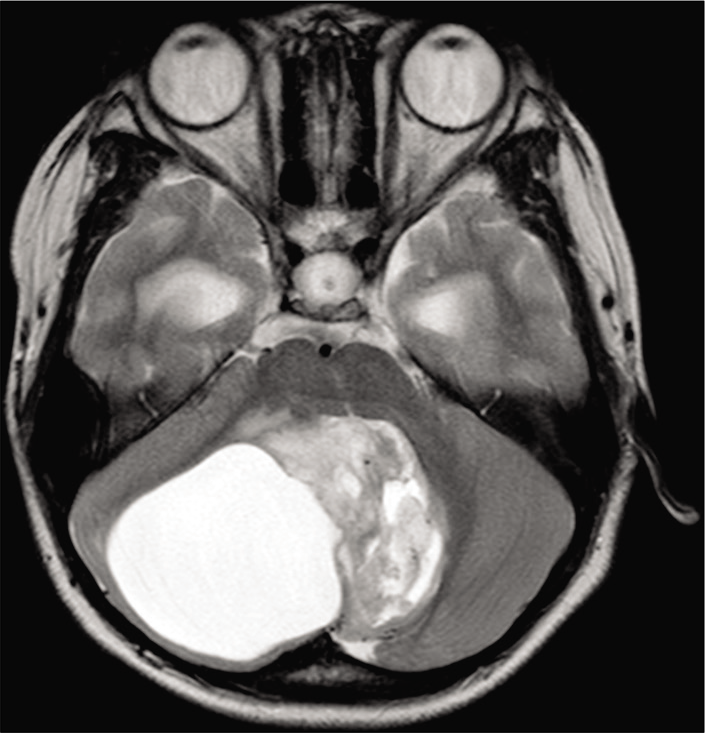 A heterogeneous mass, consisting of both solid and cystic components, located in the right cerebellar hemisphere, on axial T2-weighted imaging.