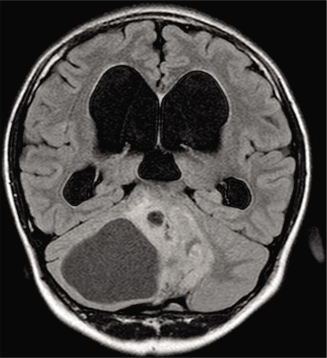 The solid portion of the tumor appears hyperintense, whereas the cystic portion of the tumor appears hypointense on coronal FLAIR (fluid-attenuated inversion recovery) imaging.