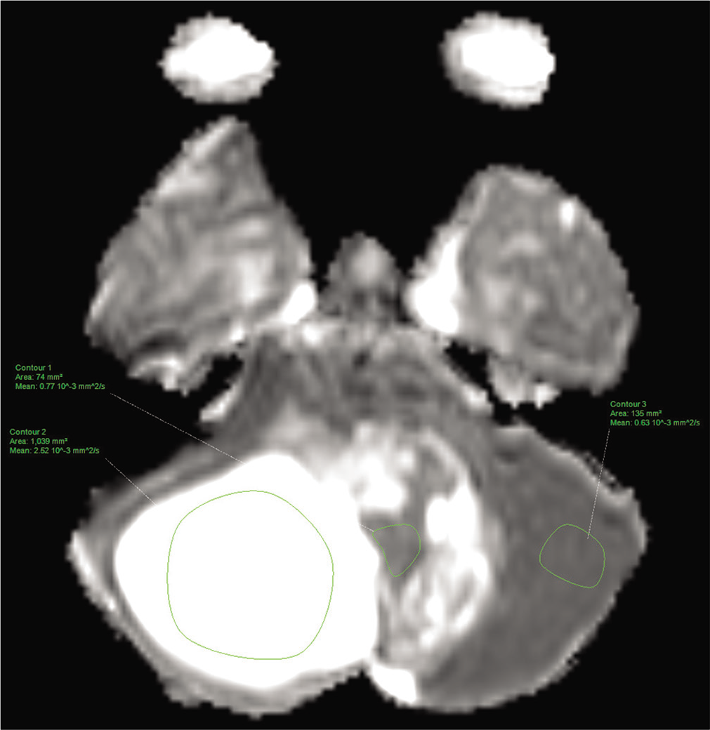 Axial apparent diffusion coefficient of the cystic and solid components of the tumor and of the parenchyma.