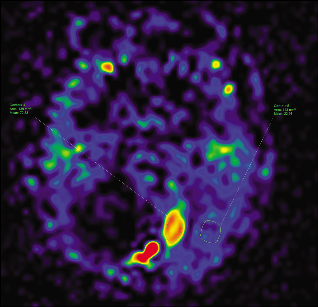 The cerebral blood flow values of the solid tumoral component and the parenchyma on 3-dimensional arterial spin labeling.