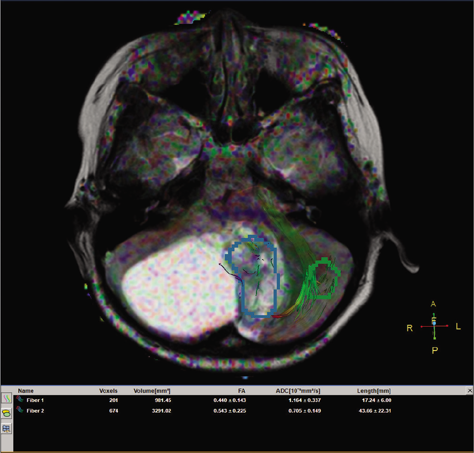 The fractional anisotropy values for the solid portion of the tumor and the parenchyma on diffusion tensor imaging.