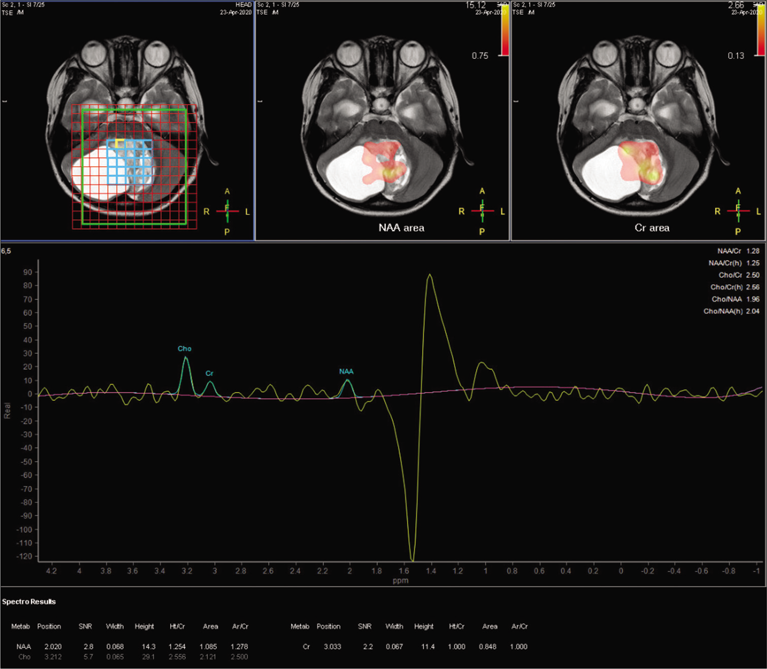 The metabolic parameters determined for the solid tumor component on MRI spectroscopy.