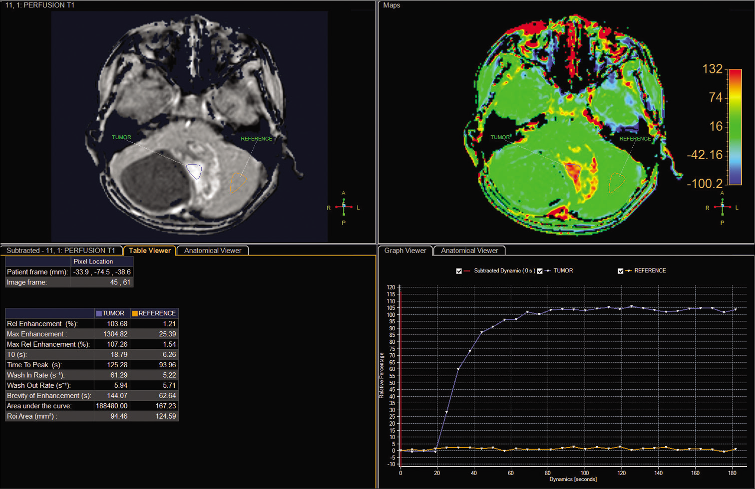 The perfusion parameters for the solid portion of the tumor and the parenchyma on the semiquantitative T1-perfusion map.