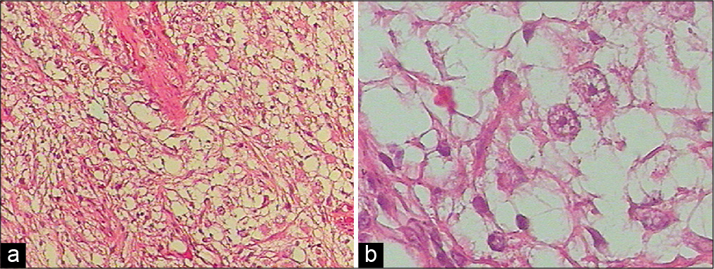 Histopathological findings for excised sample tissue revealed ganglion cells with prominent nucleoli and the diffuse proliferation of astrocytes, without necrosis (hematoxylin and eosin, × 100 (a), × 400(b)).