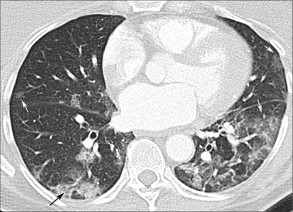 A 61-year-old female with coronavirus disease 2019 pneumonia. Ground glass opacities GGO (white arrows), predominantly in the left lower lobe, but also in the right middle lobe and the lingula. Right lower lobe consolidation with air bronchogram (black arrow).