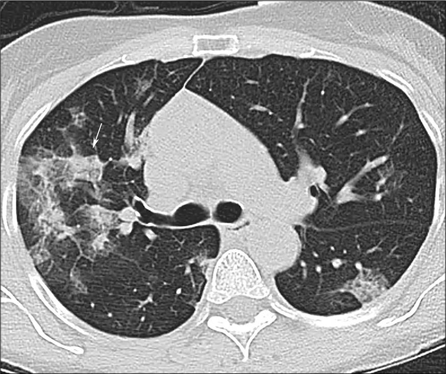 A 58-year-old male with COVID-19 pneumonia. Crazy paving sign in the right upper lobe (arrow).