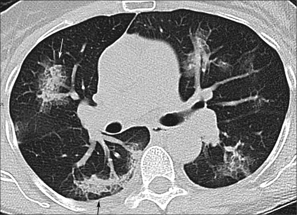 A 58-year-old male with coronavirus disease 2019 pneumonia, same patient as Figure 2, more inferior slice. “Rounded” consolidation and crazy paving in the right upper lobe (white arrow); developing reticulation in the right lower lobe (black arrow).