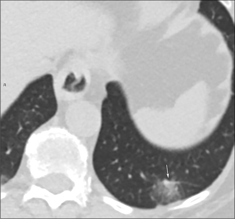 A 69-year-old female with coronavirus disease 2019 pneumonia. GGO with vascular enlargement sign in the left lower lobe (white arrow).