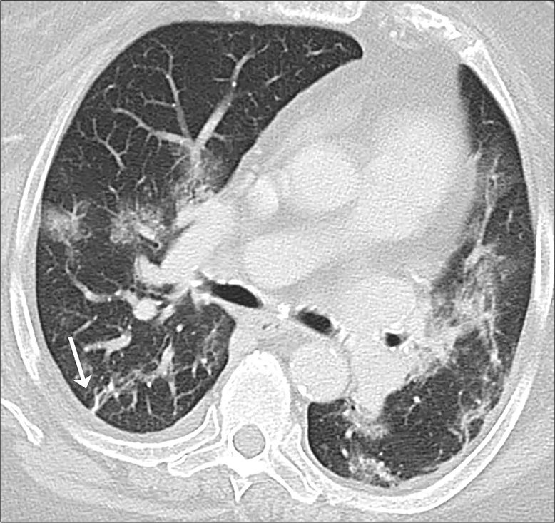 A 71-year-old female with coronavirus disease 2019 pneumonia. “Fibrous stripe” (arrow) in the right lower lobe. Other bilateral GGO and consolidations.