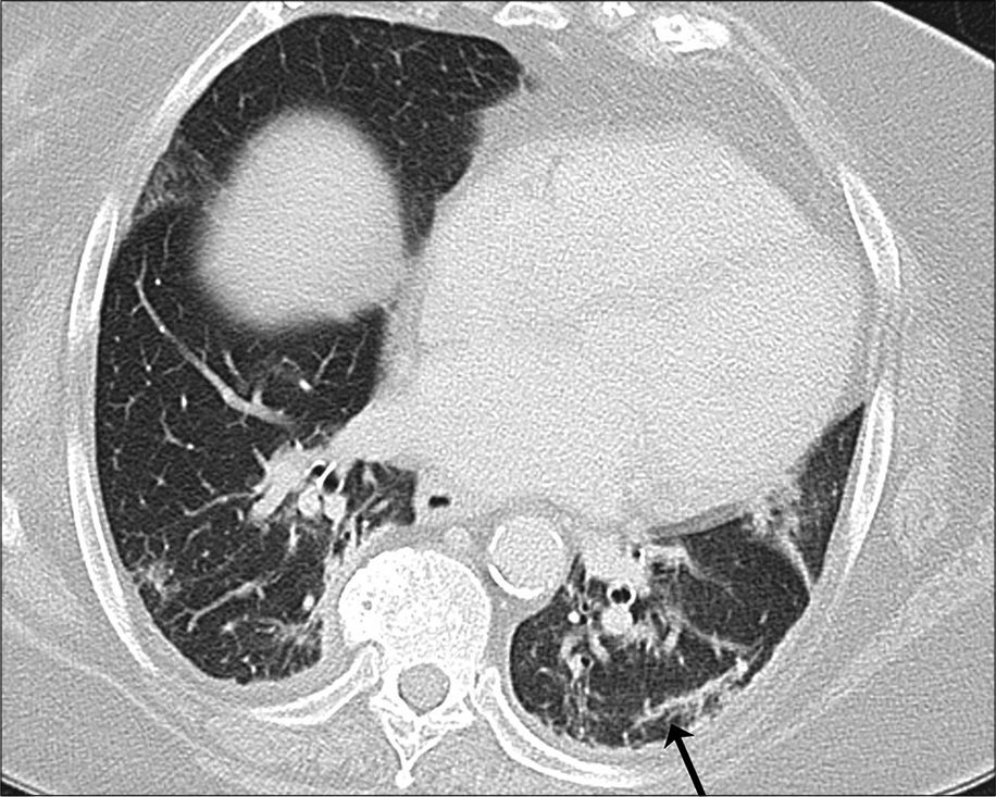 A 71-year-old with coronavirus disease 2019 pneumonia, same patient as in Figure 6, lower slice. Subpleural band (black arrow) in the right lower lobe.