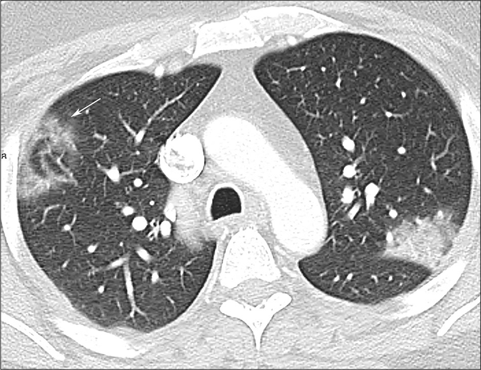 A 43-year-old male with coronavirus disease 2019 pneumonia. Reversed halo sign in the right upper lobe (arrow).