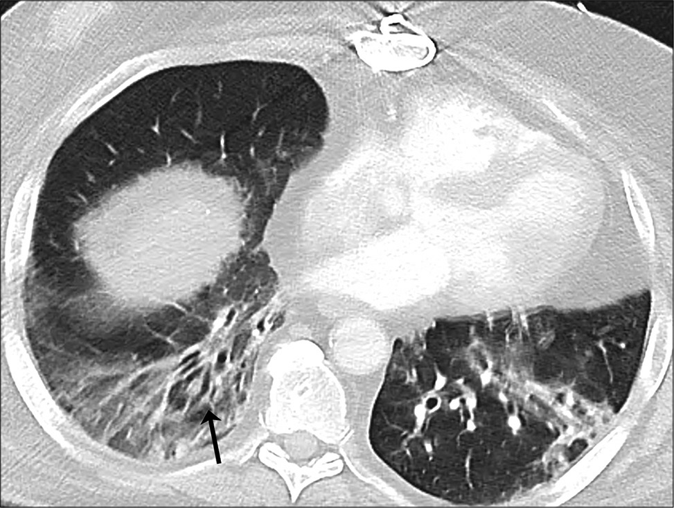 A 48-year-old female with coronavirus disease 2019 pneumonia. Traction bronchiectasis in the right lower lobe (arrow) with adjacent GGO.