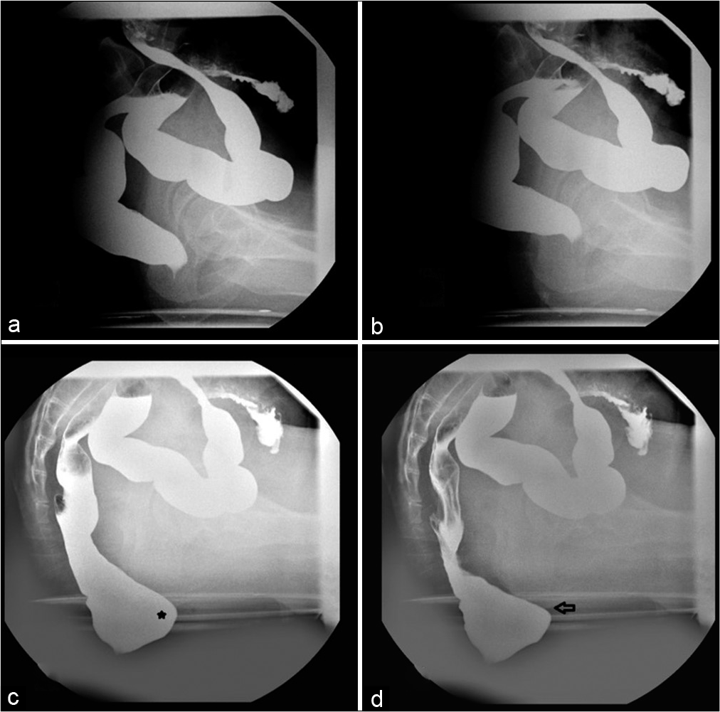 Spot radiographs of Barium proctography study of a 36-year-old lady with constipation at rest (a), pelvic lift (b), straining (c) and defecating (d). There is a small anterior rectocele (asterisk) and moderate pelvic floor descent depicted by descent of the anorectal junction below the ischial tuberosity during strain and defecation (black arrow). Magnetic resonance imaging proctography did not demonstrate these findings.