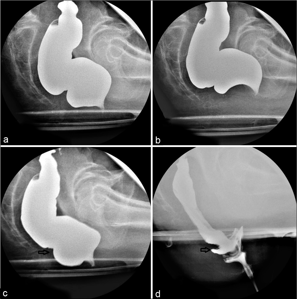 Spot radiographs of the Barium proctography study at (a) rest (b) pelvic lift (c) straining and (d) defecation of a 48-year-old lady with difficulty in defecation and micturition showed infolding of the rectal wall with a filling defect suggestive of rectorectal intussusception (arrows) and pelvic floor descent.