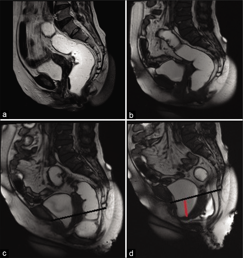 Magnetic resonance imaging proctography of the same patient as in Figure 5 showed significant pelvic floor descent with additional findings of grade 2 cystocele (red line) however could not demonstrate the intussusception. The black line depicts the pubococcygeal line.