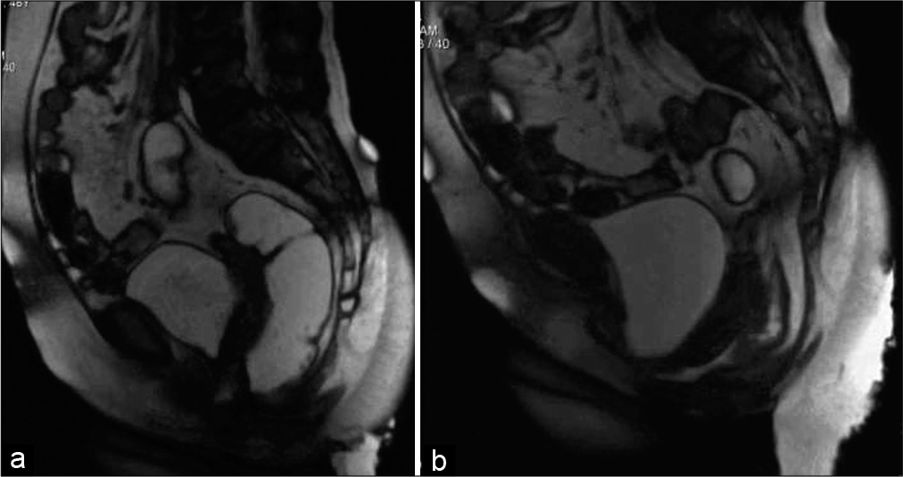 Dynamic magnetic resonance imaging proctography (of same patient as in Figure 5 in the straining (a) and defecation phase (b) showing severe pelvic floor descent, urethral hypermobility and moderate cystocele. Video is accessible from the portal.