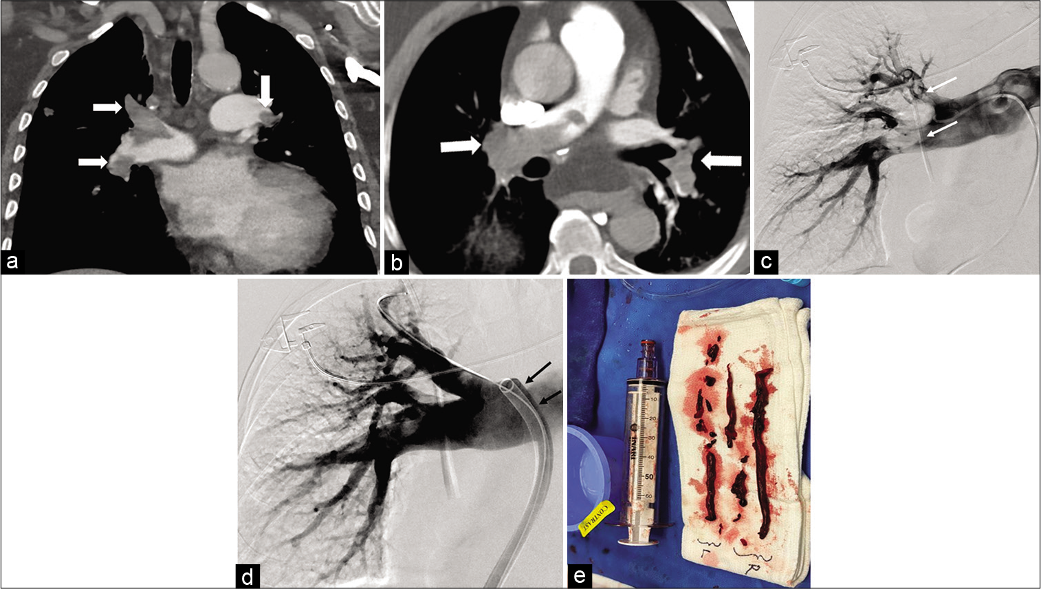 Coronal (a) and axial CT angiogram (b) of the chest in a 45-year-old male showing bilateral extensive pulmonary embolism (white arrows). Digital subtraction angiogram (DSA) of the right pulmonary artery in the same patient (c) showing multiple filling defects in the upper and lower lobar pulmonary arteries (white arrows). Follow-up DSA (d) of the same patient after mechanical thrombectomy with the FlowTriever device (black arrows) through a 22 F sheath showing near complete clearance of the clot. The aspirated clot is on shown in picture (e) (white arrows).