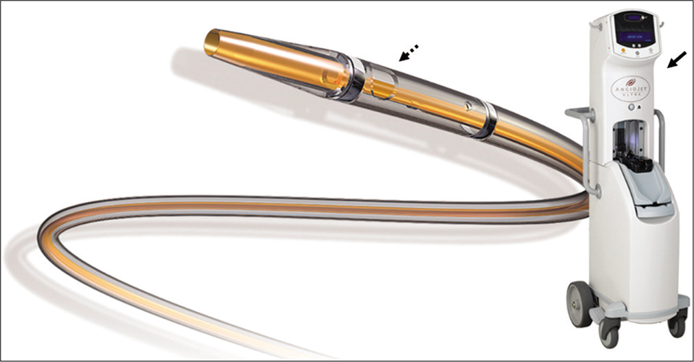 The Angiojet thrombectomy catheter (dotted black arrow) with its dive unit/pump (solid black arrow). Image provided courtesy of Boston Scientific. ©2020 Boston Scientific Corporation or its affiliates. All rights reserved.