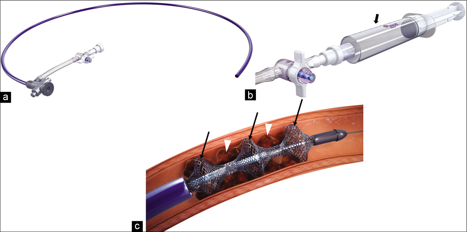 Current Endovascular Treatment Options in Acute Pulmonary Embolism