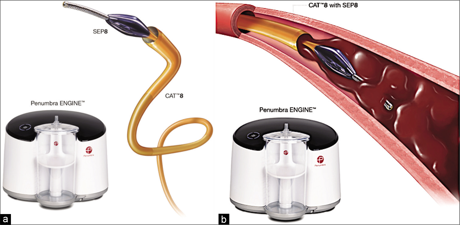 Illustration (a) of the Indigo CAT8 system with its engine and wire separator (SEP8). (b) CAT8 with deployment of the wire separator (SEP8) in the clot before aspiration. sed with permission from Penumbra, Alameda, CA.