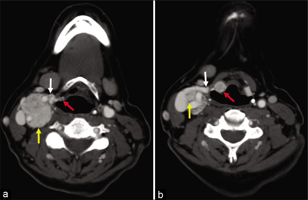 (a and b) A 58-year-old woman, axial enhanced computed tomography images obtained 5 years after Figure 1, demonstrating interval growth of the paraganglioma (yellow arrow) along the expected course of the superior laryngeal nerve (white arrow) into the paraglottic space (red arrow).