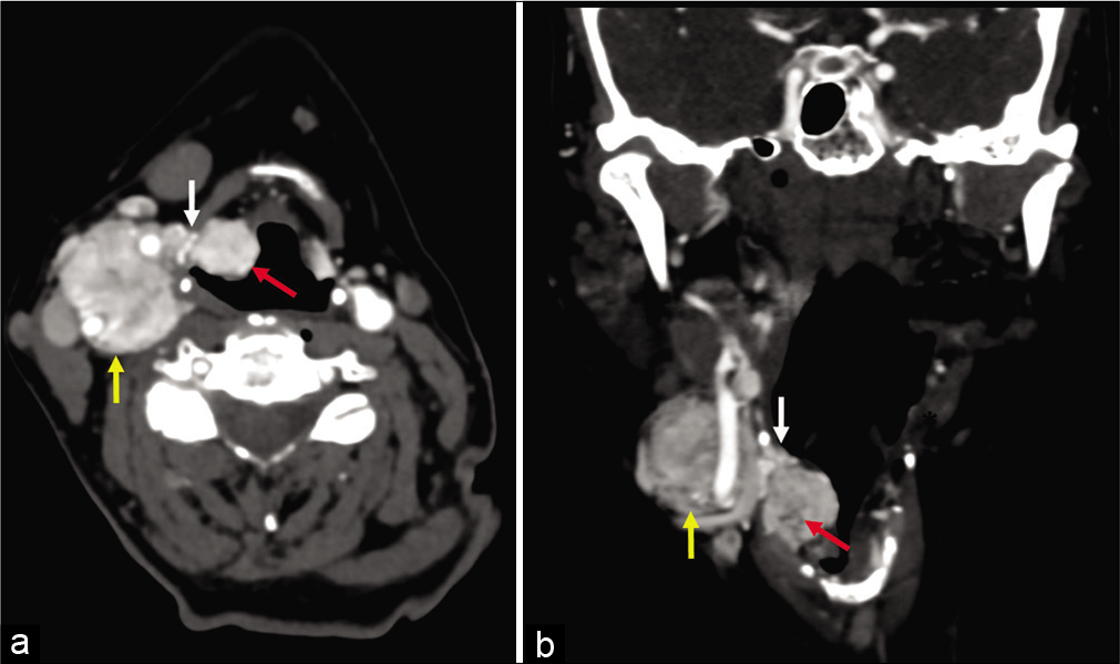 (a and b) 58-year-old woman, axial and coronal enhanced computed tomography images obtained 5 years after images in Figure 2. There has been interval enlargement of both the primary paraganglioma (yellow arrow) and the lesions within the paraglottic space (red arrow). The pedicle of tumor extending along the superior laryngeal nerve (white arrow) through the thyrohyoid membrane is also larger.