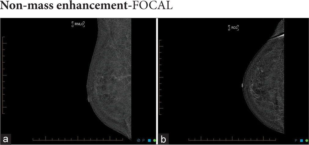 50-year-old woman with right breast pain. (a) The right mediolateral oblique and (b) craniocaudal recombined images show no suspicious mass or non-mass enhancement. There is a tiny focus of contrast uptake in the right upper outer breast only, too small for further characterization.