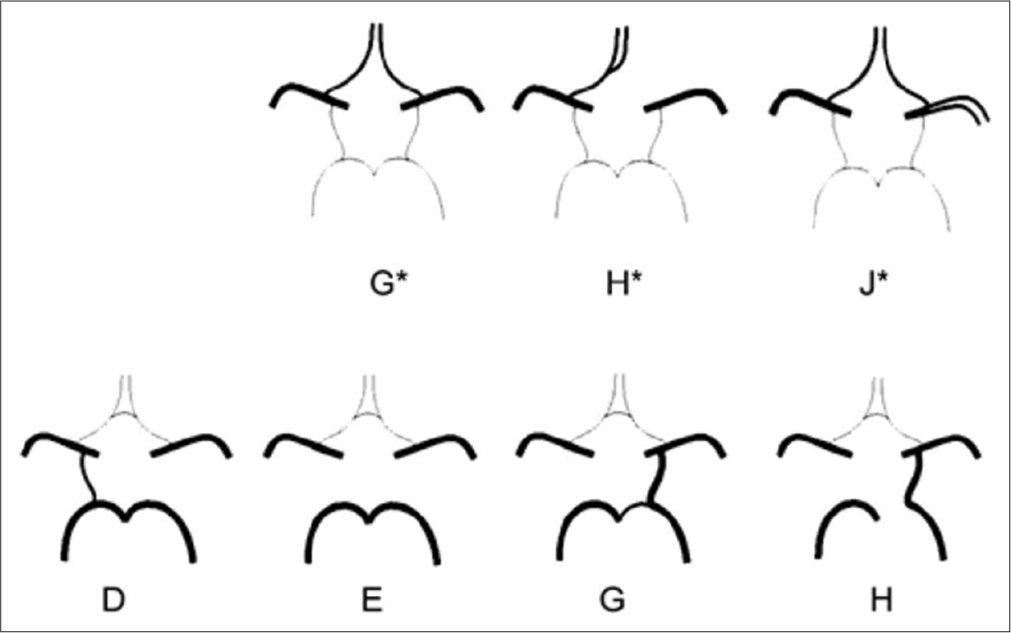 Schematic view of anatomic variations of anterior and posterior part. (G*) Hypoplasia or absence of an anterior communication. (H*) One pre-communicating segment of an anterior cerebral artery-A1 (ACA) is hypoplastic or absent, the other pre-communicating segment gives rise to both post-communicating segments of the ACAs. (J*) Hypoplasia or absence of an anterior communication. (D) Unilateral PComA present. (E) Hypoplasia or absence of both posterior communicating artery (PComA) and isolation of the anterior and posterior parts of the circle at this level. (G) Unilateral fetal-type posterior cerebral artery and hypoplasia or absence of the contralateral PComA. (H) Unilateral fetal-type posterior cerebral artery and hypoplasia or absence of both pre-communicating segments of the posterior cerebral artery and the PComA.