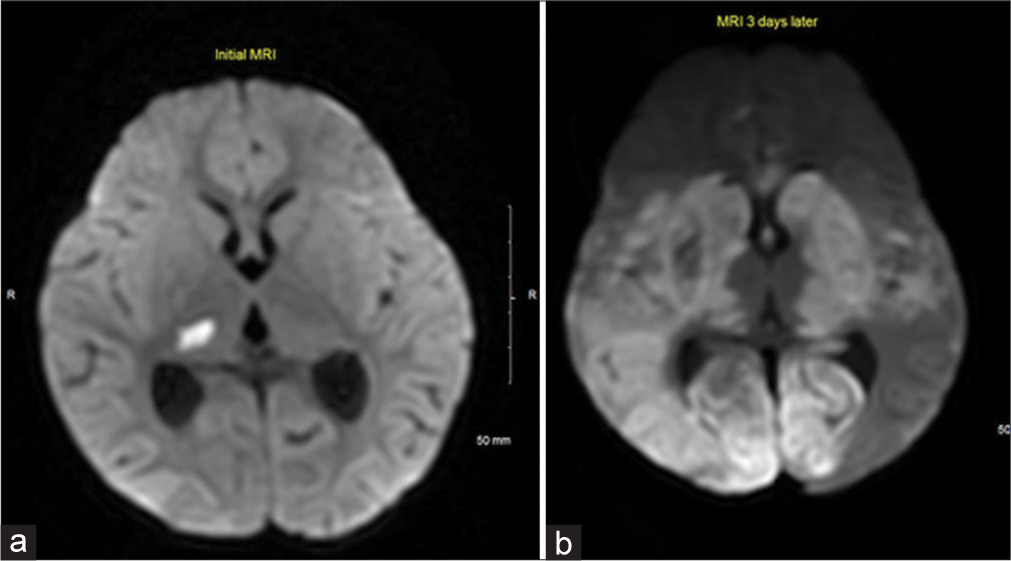 Eleven months old with fever and progressive neurological symptoms. Selected axial DWI image from the initial MRI brain (a) shows a focal punctate area of restricted diffusion, likely small infarctions involving the right thalamus. Follow-up MRI 3 days later (b) at the same level reveals marked progressively restricted diffusion of both cerebral hemispheres and bilateral deep gray nuclei (caudate, thalami, and lentiform nuclei).