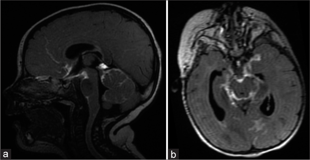 Eleven months old with fever and progressive neurological symptoms. Midline sagittal cube FLAIR post-contrast image of the brain (a) from the initial MRI demonstrates marked meningeal enhancement of the inferior frontal lobes, brainstem, and cerebellum with a thick enhancement of the basal cisterns. Axial post-contrast T1-FLAIR image (b) at the level of the basal cisterns shows characteristic encasement by thick enhancing exudates lining these cisterns.