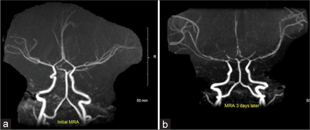 Eleven months old with fever and progressive neurological symptoms. Initial MRA (a) is within normal limits. Follow-up MRA (b) performed 3 days later reveals progressive areas of proximal narrowing and irregularity of A1, M1, and P1 segments of the ACA, MCA, and PCA, respectively.