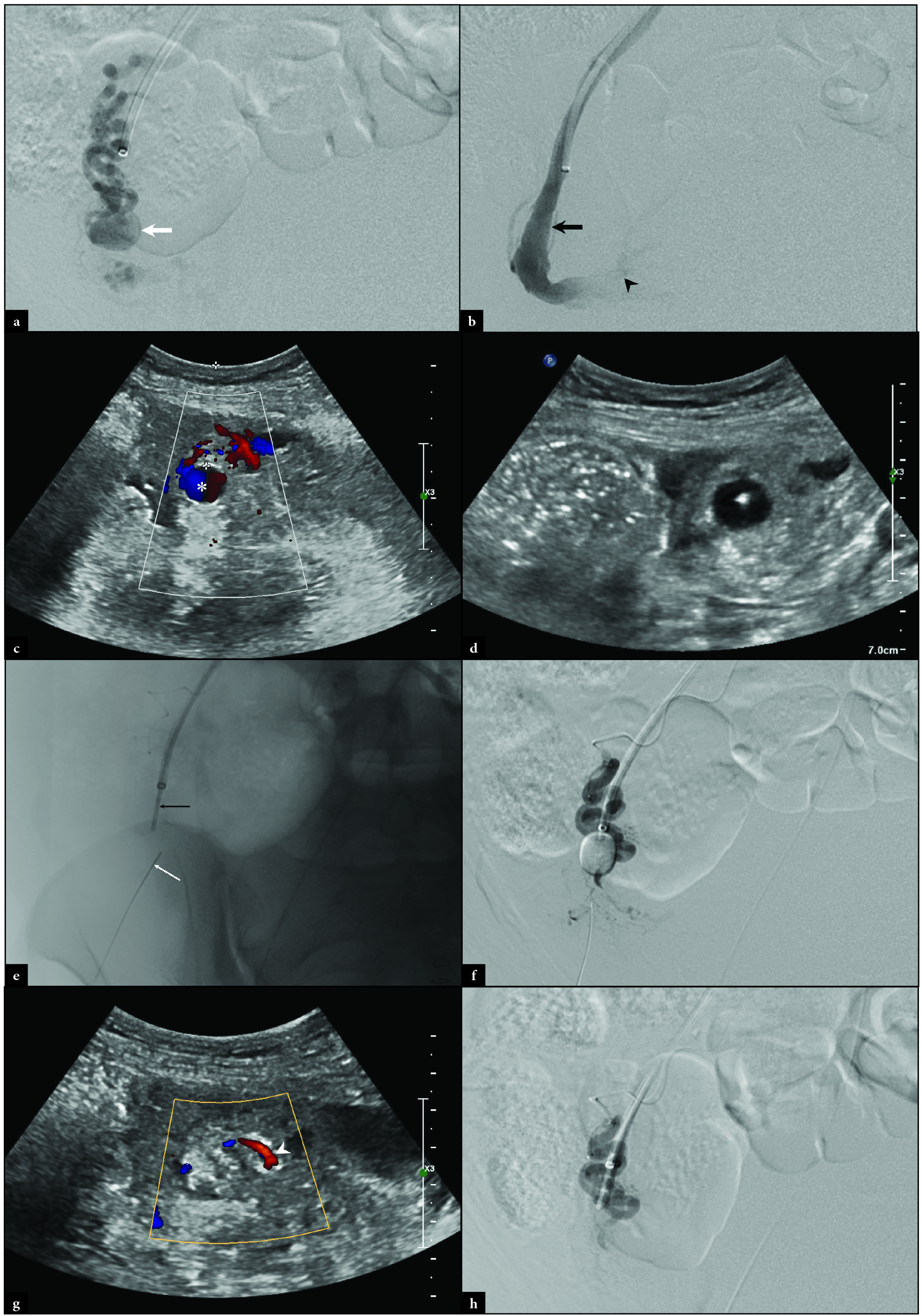 Intraprocedural right ovarian arteriography revealing (a) a distal OAA (white arrow). Right ovarian venography reveals (b) a patent right ovarian vein (black arrow) with retrograde contrast flowing into the pelvis (black arrowhead). Direct ultrasound of the OAA demonstrates (c) the “ying-yang” sign (white asterisk) and (d) a 21-gauge Chiba needle placed under ultrasonographic guidance. Fluoroscopy demonstrates (e) the Chiba needle (thin white arrow) in the OAA with an uninflated Fogarty balloon (thin black arrow) in the ovarian vein. Digital subtraction right ovarian arteriography demonstrates (f) the inflated Fogarty balloon in the right ovarian vein with the Chiba needle in the OAA. Post-thrombin injection ultrasound shows (g) thrombosis of the right OAA with flow (white arrowhead) in the adjacent ovarian artery. Post-thrombin injection digital subtraction arteriography demonstrates (h) patency of the ovarian artery without visualization of the OAA.