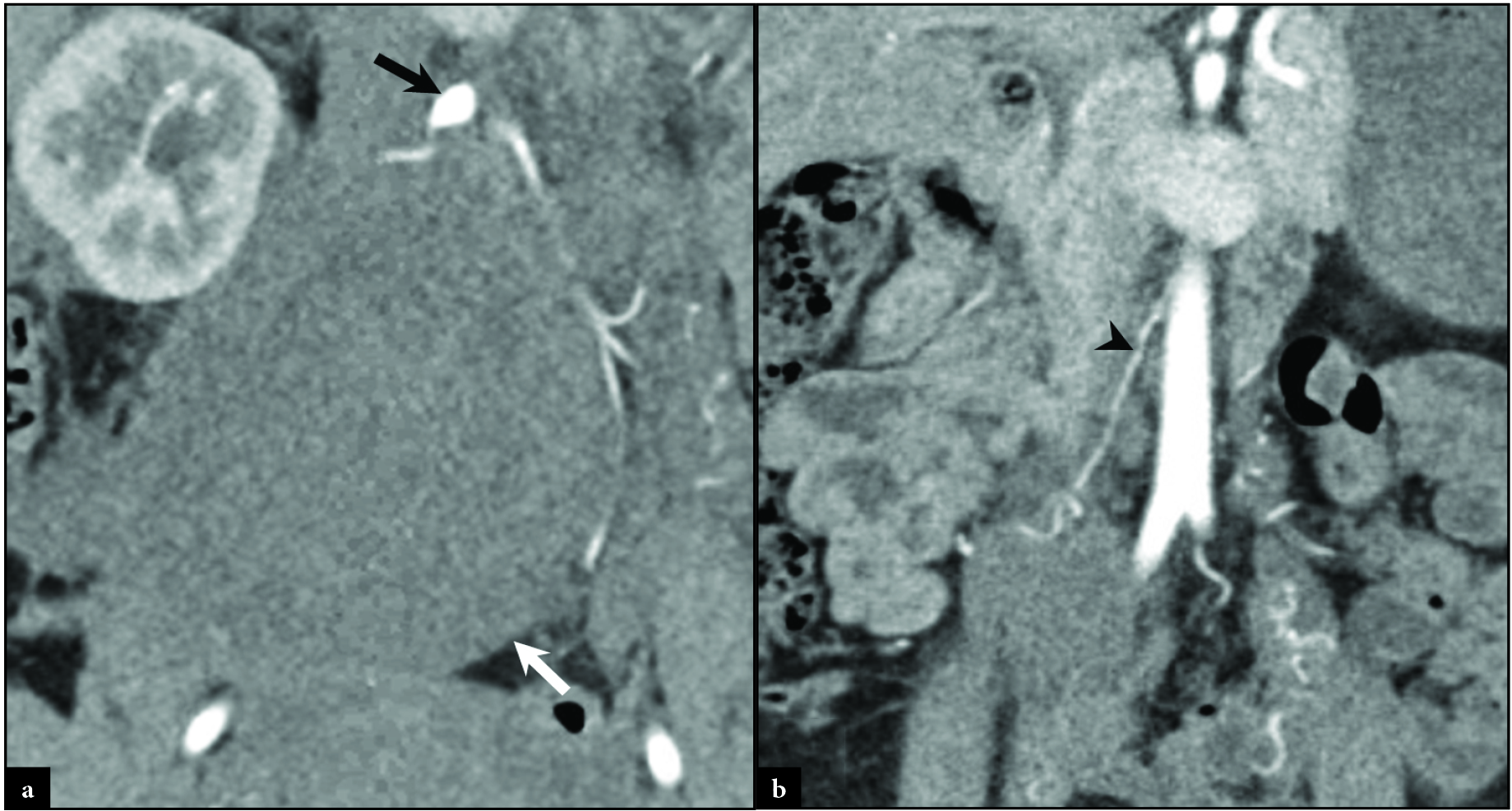Follow up coronal CT imaging for a 32-year-old woman who underwent successful treatment for a right ovarian artery pseudoaneurysm rupture was performed. Two-week follow-up CT imaging (a) demonstrates resolution of the ruptured OAA, a residual proximal right ovarian artery aneurysm (black arrow), and an evolving hematoma (white arrow). One year follow-up CT imaging (b) demonstrates resolution of the proximal right ovarian artery aneurysm (black arrowhead) and hematoma.