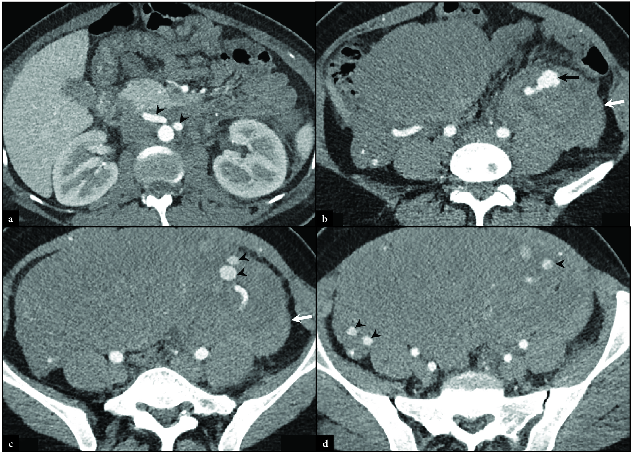 Axial CT of a 28-year-old woman, gravida 7 para 3, with severe post-partum left flank pain revealed (a-d) multifocal aneurysmal dilations of the proximal and distal ovarian arteries (black arrowheads) and an enlarged aneurysm (black arrow) at the site of hematoma (white arrows).
