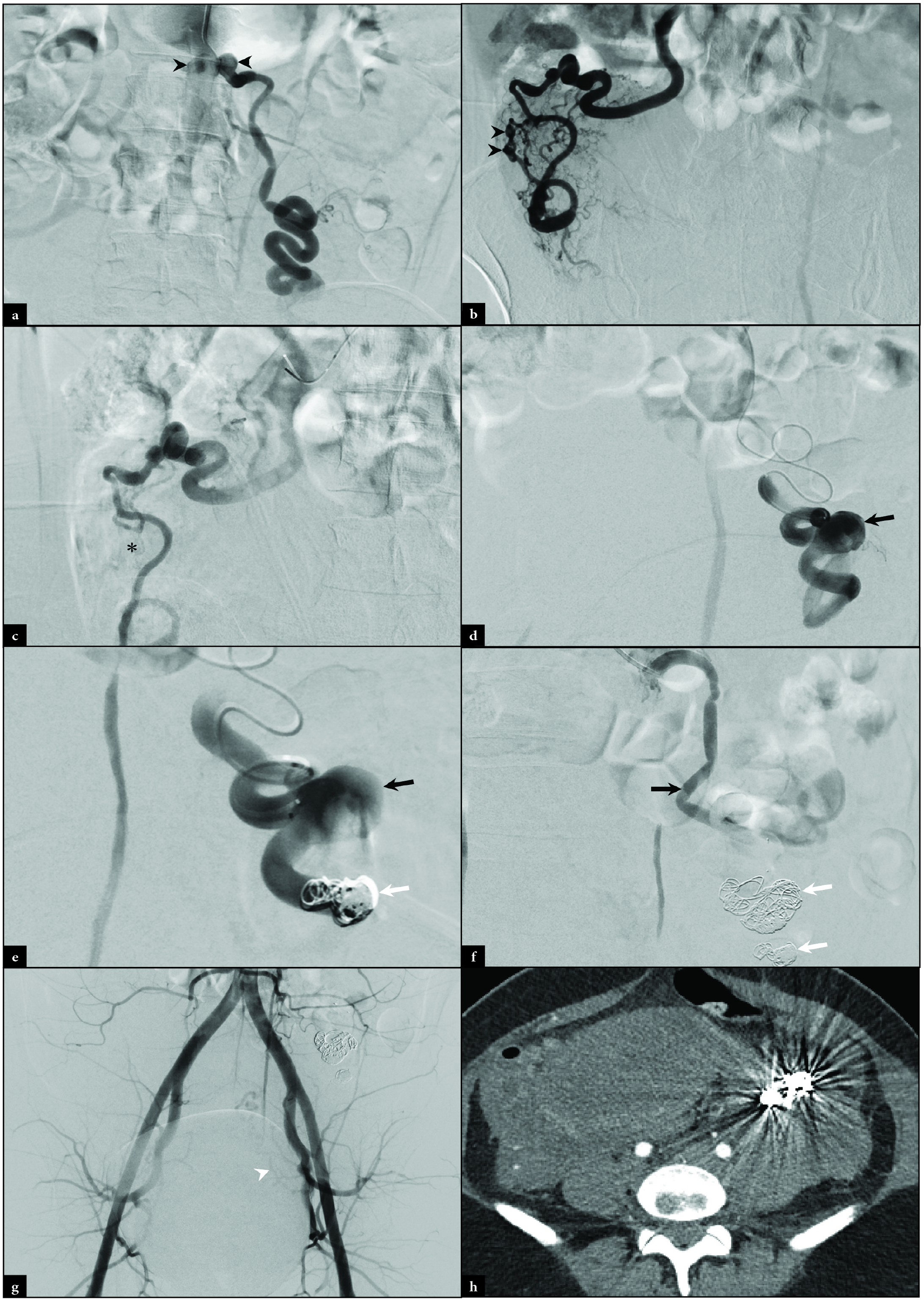 Intraprocedural angiography of a 28-year-old woman, gravida 7 para 3, with severe post-partum left flank pain revealed at the level of the left and right ovarian arteries demonstrates (a) bilateral proximal aneurysms (black arrowheads). Right ovarian angiography demonstrates (b) multifocal aneurysmal dilation distally (black arrowheads). After Gelfoam embolization, right ovarian angiography demonstrates (c) contrast staining and static flow through the aneurysmal sites (black asterisk). Left ovarian arteriography demonstrates (d) a large aneurysm (black arrow). Left ovarian arteriography was performed after (e) distal Gelfoam and coil (white arrow) embolization. (f) Proximal coiling (white arrows) was also completed. Completion pelvic angiography (g) demonstrates an absent right uterine artery and diminutive left uterine artery (white arrowhead). Follow up axial CT demonstrates (h) artifact from coil embolization.