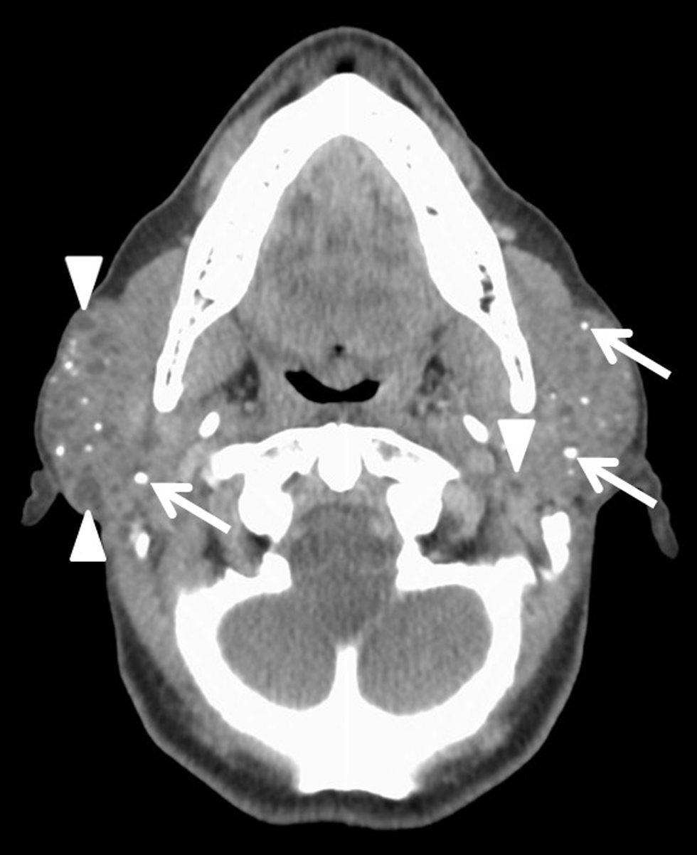 A 66-year-old female with a history of Sjogren’s syndrome presents with bilateral facial swelling and palpable mass on the right. Axial contrast-enhanced CT image demonstrates enlarged, heterogeneous bilateral parotid glands with multiple calcifications (white arrows) and small cysts (arrowheads), consistent with chronic inflammation