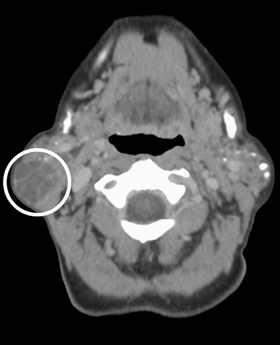 A 66-year-old female with a history of Sjogren’s syndrome presents with bilateral facial swelling and palpable mass on the right. Axial contrast-enhanced CT image demonstrates a well-circumscribed (smooth, peripherally enhancing capsule), predominantly low attenuating lesion within the tail of the right parotid gland (circled). The lesion has thin, enhancing internal septa. Pathology proven sebaceous lymphadenoma