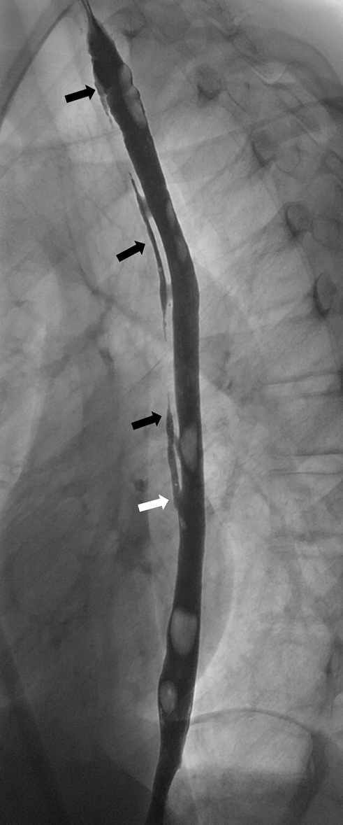 A 15-year-old boy was referred for a barium swallow investigation as part of a workup for chronic dysphagia and odynophagia. His symptoms commenced after the endoscopic removal of an impacted tablet several years earlier. (b) A lateral image of the full length of the thoracic esophagus demonstrates the entirety of the esophageal dissection and a so-called “double-barrel esophagus” (black arrows). The false lumen is seen to merge distally into the true lumen (white arrow).